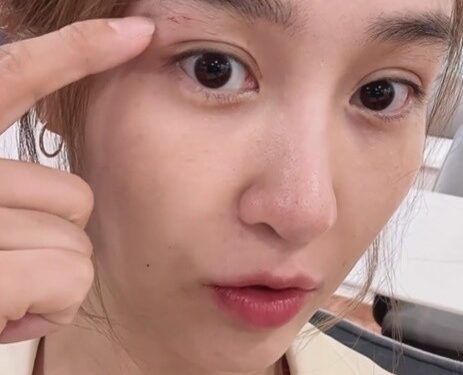 옥주현, 일본서 얼굴 부상…선명한 꿰맨 자국