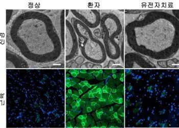 손발 굽는 희귀 유전병 ‘샤르코마리투스병’…원인·치료법 최초 발견