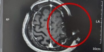 “MRI가 왜 이러지?”…유명 대학병원서 뇌수술 환자 머리뼈에 ‘톱날’ 콕