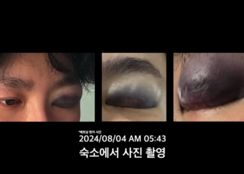 베트남 여행 갔다 ‘의문의 폭행’ 당한 유튜버… 한국선 ‘응급실 뺑뺑이’ 2시간