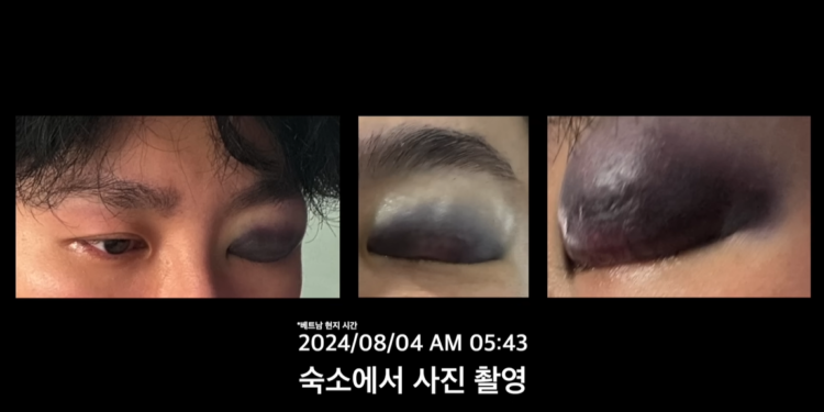 베트남 여행 갔다 ‘의문의 폭행’ 당한 유튜버… 한국선 ‘응급실 뺑뺑이’ 2시간