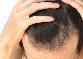 탈모 스트레스 얼마나 심하길래… “관련 화장품 특허출원 한국이 세계 1위”