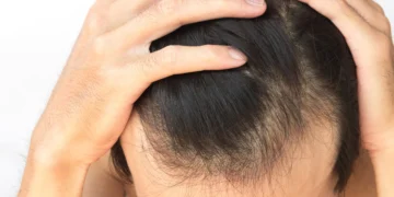 탈모 스트레스 얼마나 심하길래… “관련 화장품 특허출원 한국이 세계 1위”