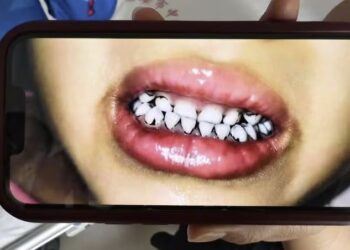 머리 빠지고 잇몸엔 반점… ‘납중독’ 공포 휩싸인 中유치원