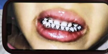 머리 빠지고 잇몸엔 반점… ‘납중독’ 공포 휩싸인 中유치원