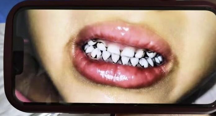 머리 빠지고 잇몸엔 반점… ‘납중독’ 공포 휩싸인 中유치원