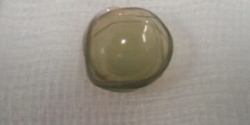 “렌즈 낀 것 깜빡하고 또 꼈다”…눈에서 콘택트렌즈 27개 뭉쳐 나온 60대女