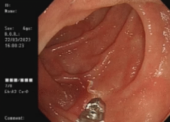 “내시경서 4마리가 꿈틀”…10년 만에 나타난 희귀기생충