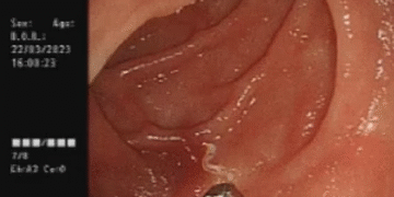 “내시경서 4마리가 꿈틀”…10년 만에 나타난 희귀기생충