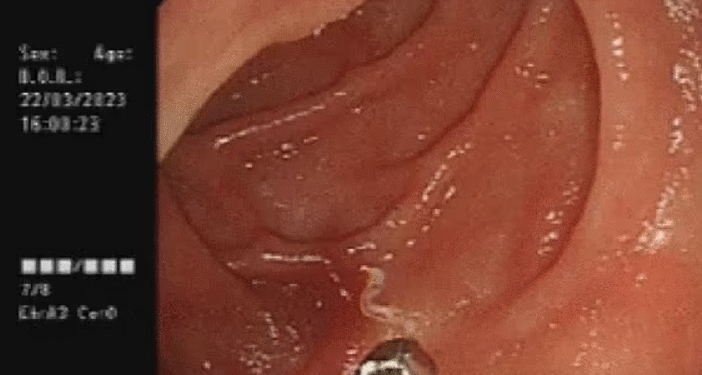 “내시경서 4마리가 꿈틀”…10년 만에 나타난 희귀기생충