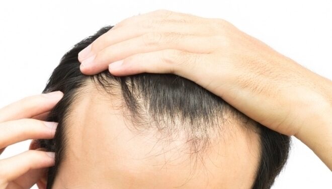 “가발을 속여”…결혼 전 탈모 숨긴 남편 고소한 인도女